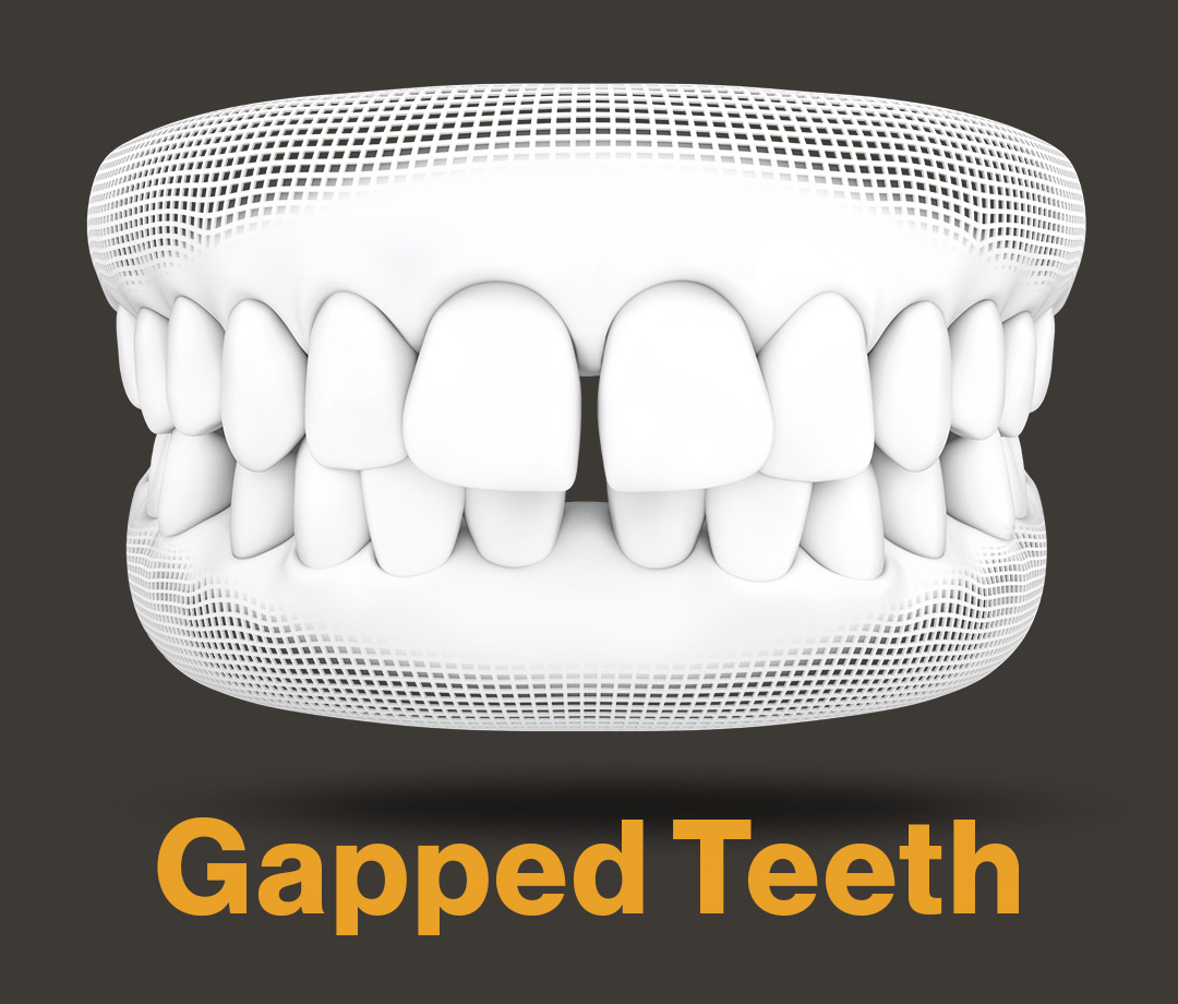 invisalign aligners